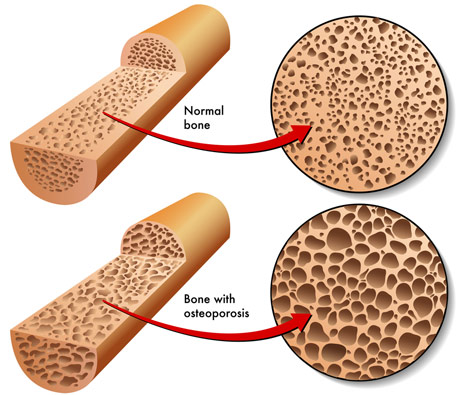 Bone Mineral Density & Osteoporosis