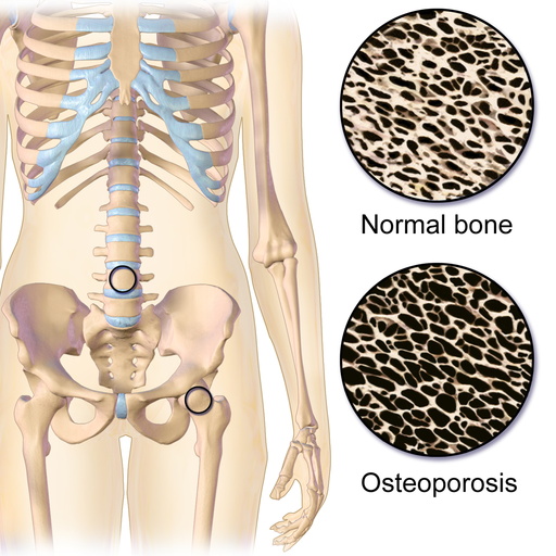 reverse Osteoporosis